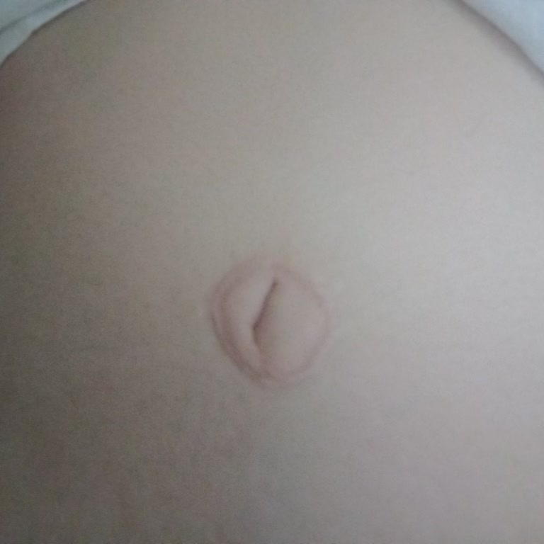 Karın Germe Ameliyatı Sonrası Göbek Deliğim Kötü Durumda, Pişman Oldum