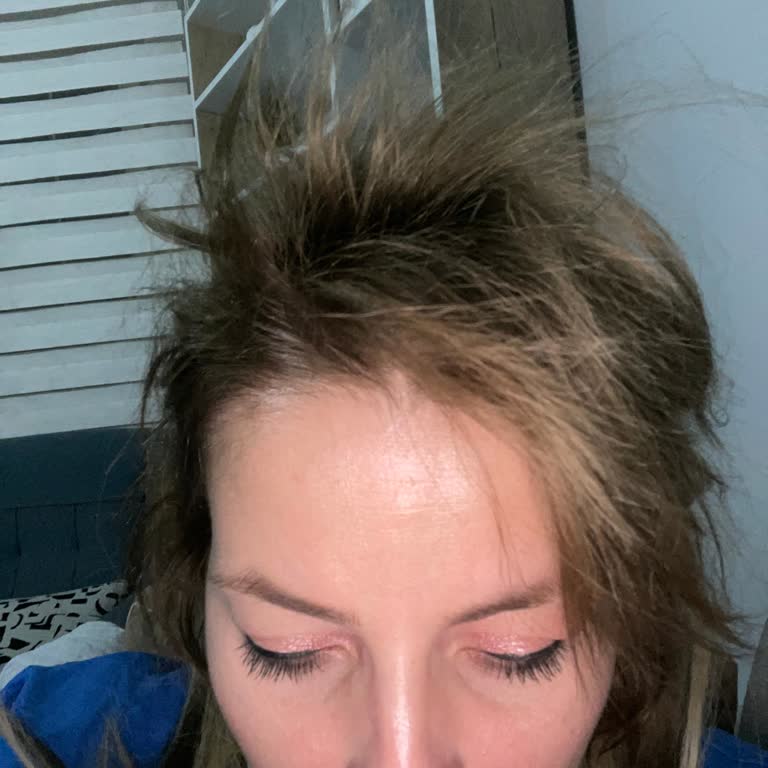 Aldığım Saç Boyası Saçlarımı Yaktı Ve Dökülmesine Sebep Oldu