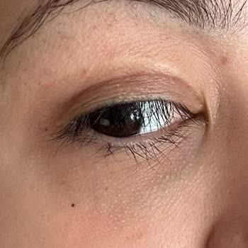 Medilift Sonrası Geçmeyen Morluk Ve Acı Deneyimi