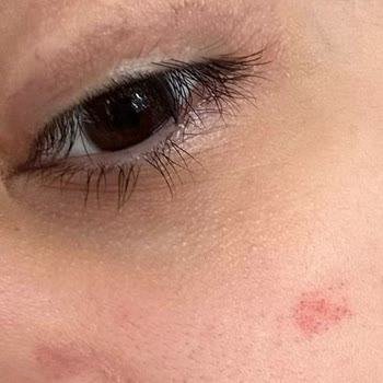 Medilift Sonrası Geçmeyen Morluk Ve Acı Deneyimi