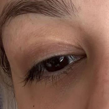 Medilift Sonrası Geçmeyen Morluk Ve Acı Deneyimi