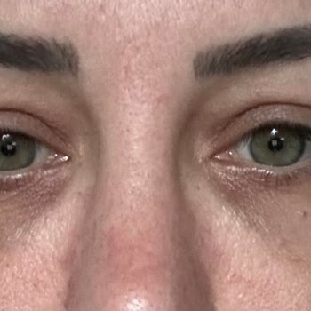 Medilift Sonrası Geçmeyen Gözaltı Morluğu Ve Şişlik Mağduriyeti