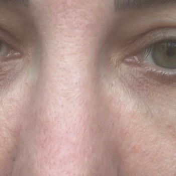 Medilift Sonrası Geçmeyen Gözaltı Morluğu Ve Şişlik Mağduriyeti