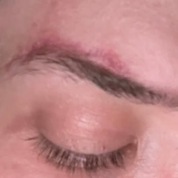 Dr. Estetik Nargiz Evinin Odasında Yaptığı İşlemle Yüzümü Mahvetti