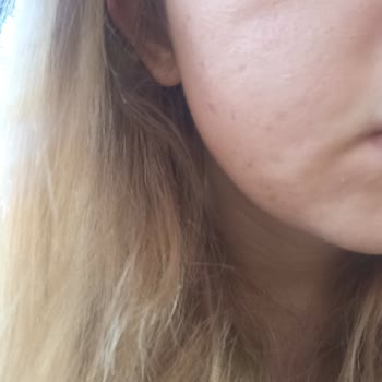 Aldığım Akne Kremi Ve Serumu Yüzümde Alerji Yaptı, İade Sorunu Yaşıyorum