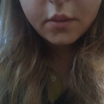 Aldığım Akne Kremi Ve Serumu Yüzümde Alerji Yaptı, İade Sorunu Yaşıyorum