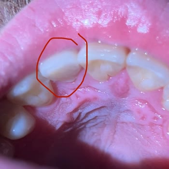 Yanlış Yapılan Dolgu Yüzünden Dişim Düzleşti Ve Ağrım Geçmedi