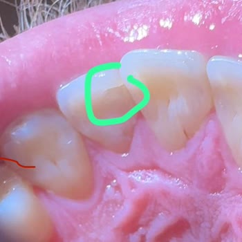 Yanlış Yapılan Dolgu Yüzünden Dişim Düzleşti Ve Ağrım Geçmedi