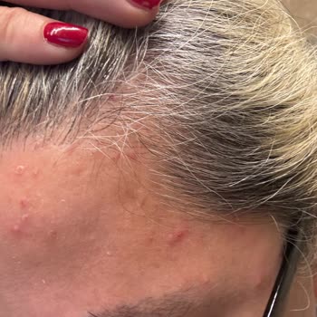 Saç Bakım Kompleksi Kullanımı Sonrası Sivilce Ve Yara Sorunu