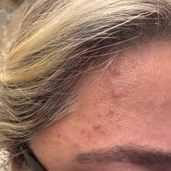 Saç Bakım Kompleksi Kullanımı Sonrası Sivilce Ve Yara Sorunu