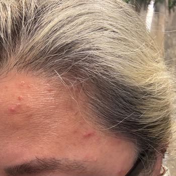 Saç Bakım Kompleksi Kullanımı Sonrası Sivilce Ve Yara Sorunu