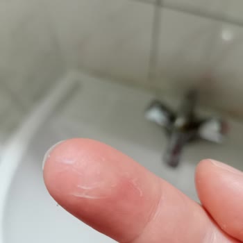 Sensodyne отбеливающая зубная паста — появилось шелушение во рту