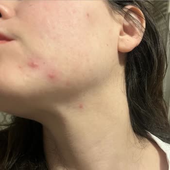 Clinique All About Eyes Cream Gave Me a Severe Allergic Reaction