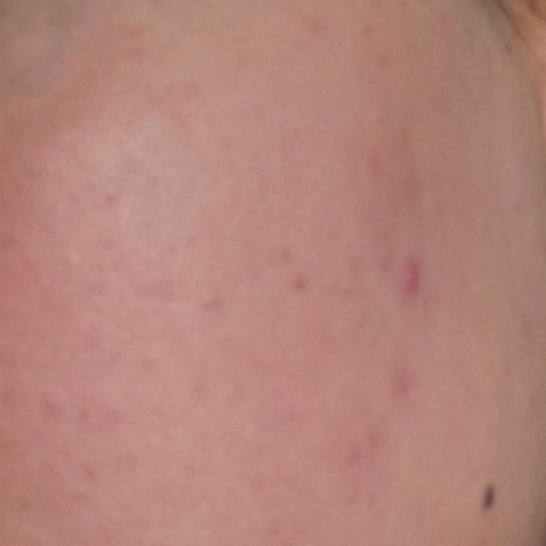 I Got Breakouts and Bumps After Using Nivea Derma Skin Clear