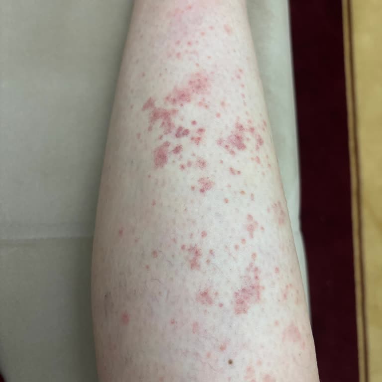 Lazer Epilasyon Sonrası Cilt Yanığı Ve İlgisizlik Nedeniyle Mağduriyet