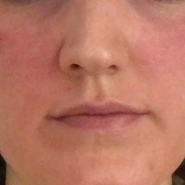 I Experienced Severe Irritation and Swelling from Bioderma Pigmentbio SPF 50 Cream