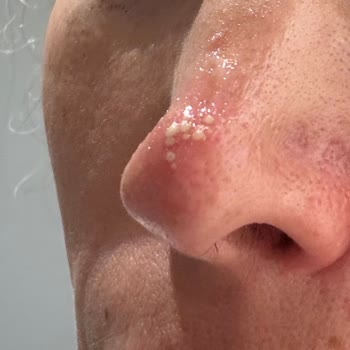 Burun Bandı Kullanımı Sonrası Ciltte Kızarıklık Problemi