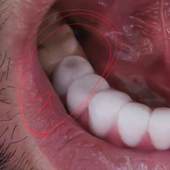 Zirkonyum Dişler 4 Yılda Kırıldı, Klinik İlgisiz Ve Garanti Yok