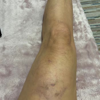 Tedavi Yarıda Bırakıldı, Hasta Bilgilendirilmedi Ve Şikayetlerim Dikkate Alınmadı