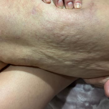 Tedavi Yarıda Bırakıldı, Hasta Bilgilendirilmedi Ve Şikayetlerim Dikkate Alınmadı