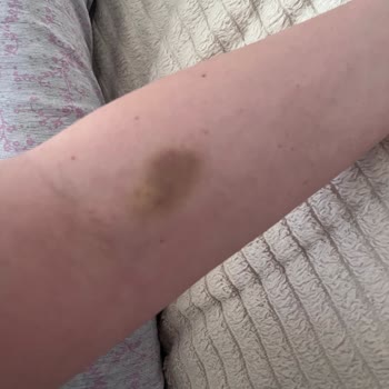 Damar Yolu Açmada Yetersiz Hemşireler Yüzünden Mağduriyet