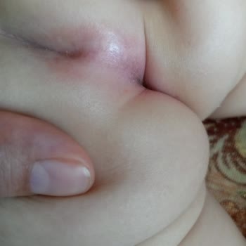 Molfix 5 Numara Bez Oğlumda Alerji Ve Pişik Yaptı