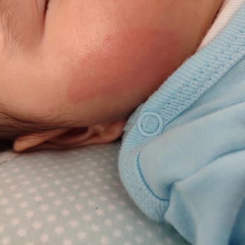 Mustela Krem Bebeğimin Cildinde Alerji Ve Kızarıklık Yaptı