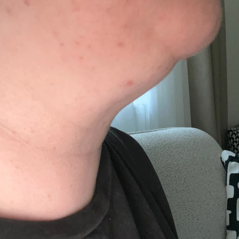 Gıdı Liposuction Sonrası Sorunlar Ve Yetersiz Sonuç