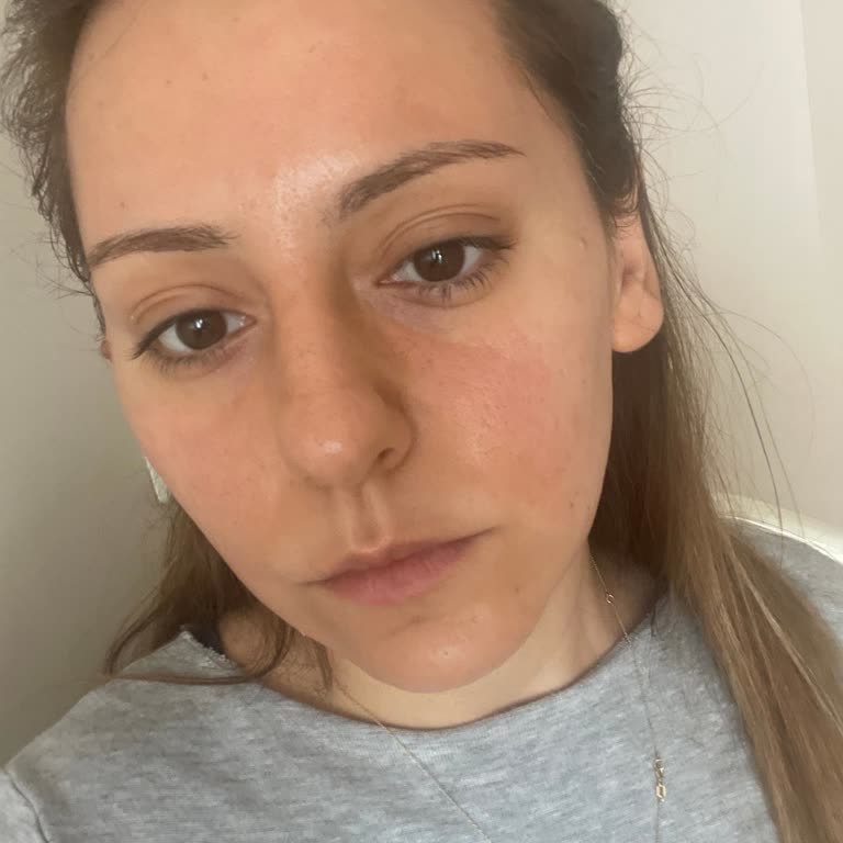 Reacción alérgica grave tras usar tónico azul L'Occitane