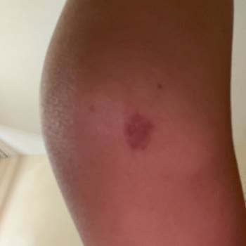 Lazer Epilasyon Sonrası Yanık Ve Merkezin İlgisiz Davranışı