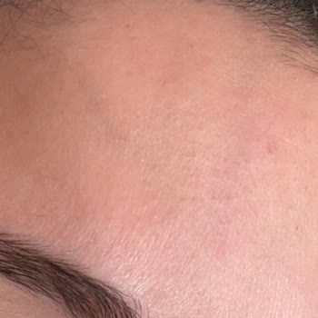 Productos L'Occitane para piel seca causan picazón y acné, solicito reembolso