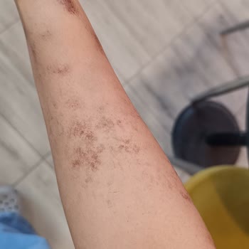 Lazer İşlem Sonrası Yanıklar Ve Merkezin Sorumluluk Almaması