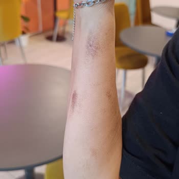 Lazer İşlem Sonrası Yanıklar Ve Merkezin Sorumluluk Almaması