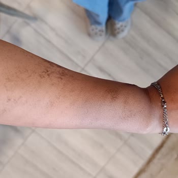 Lazer İşlem Sonrası Yanıklar Ve Merkezin Sorumluluk Almaması