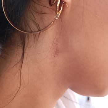 Lazer İşlem Sonrası Yanıklar Ve Merkezin Sorumluluk Almaması