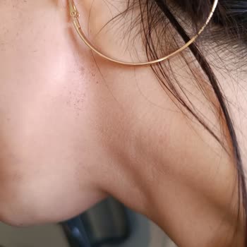 Lazer İşlem Sonrası Yanıklar Ve Merkezin Sorumluluk Almaması