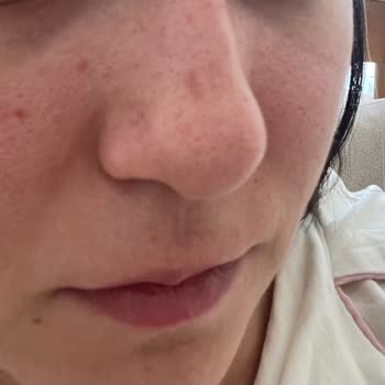 Arven Güzellik Cilt Bakımı Diye Cildimi Mahvetti