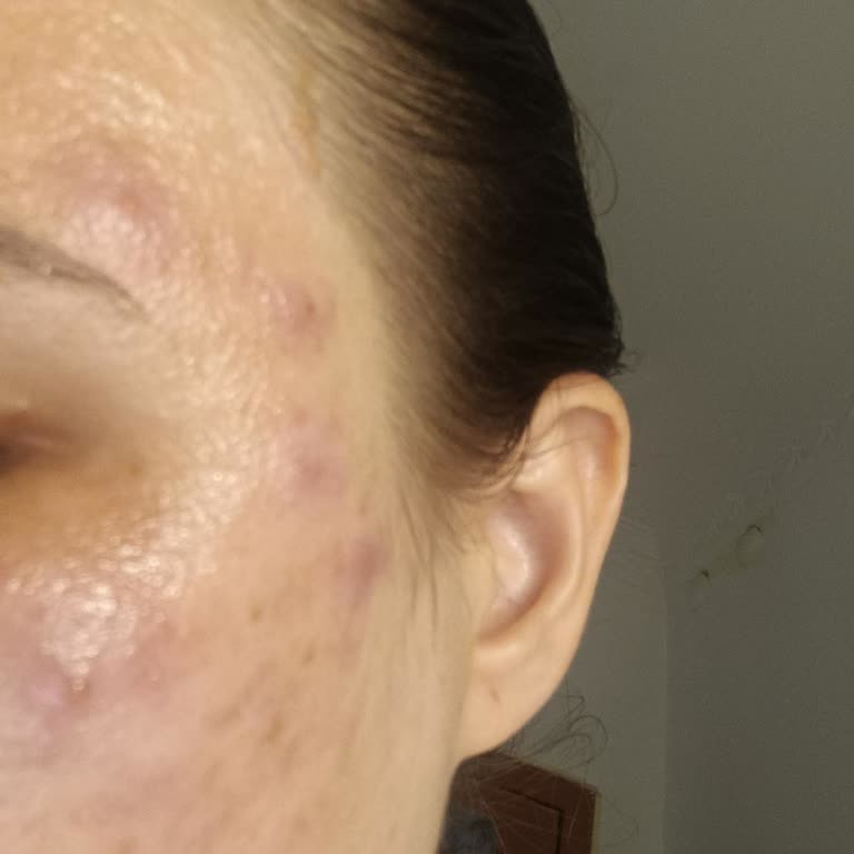 Avene Yüz Yıkama Köpüğü Sonrası Cilt Sorunu Ve Firma Dönüşü Alamama