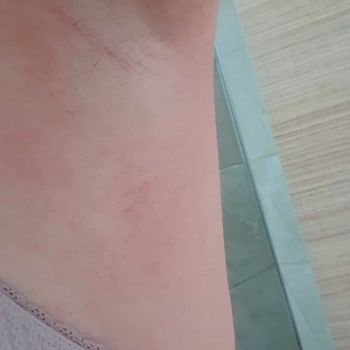 Rexona Clinical Protection Gave Me Severe Itching and Allergic Reaction at Night