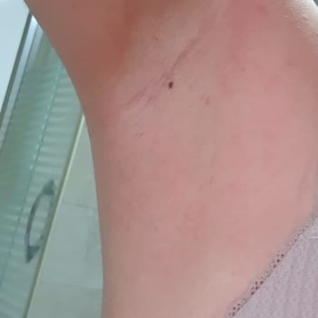 Rexona Clinical Protection Gave Me Severe Itching and Allergic Reaction at Night