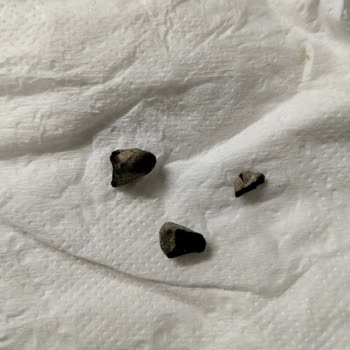 Garnitürden Taş Çıktı, Sağlığımız Tehlikede!