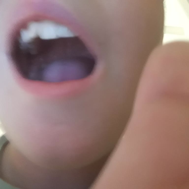 Schnitzel İçinde Kemik Çıktı, Oğlumun Dişi Kırıldı