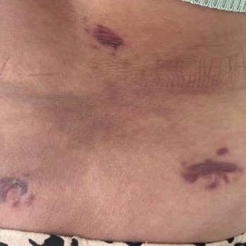 Ameliyat Sonrası Enfeksiyon Ve Başarısız Tedavi Sonucu Hayati Tehlike Yaşadım