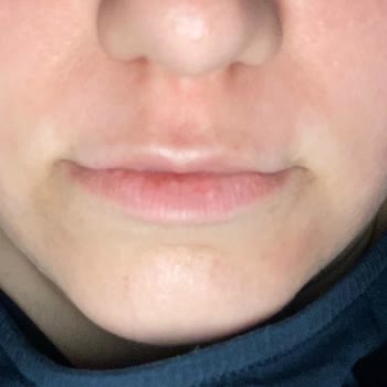 Yüz Temizleme Ürünü Cildimde Yanık Ve İzlere Sebep Oldu