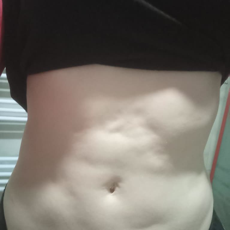 Dr. Esabil Eker Liposuction Sonrası Vücudumda Kalıcı Hasar Oluştu, Doktor İlgilenmedi!