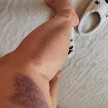 İlk Kullanımda Kırılan Merdiven Ve Yetersiz Müşteri Desteği