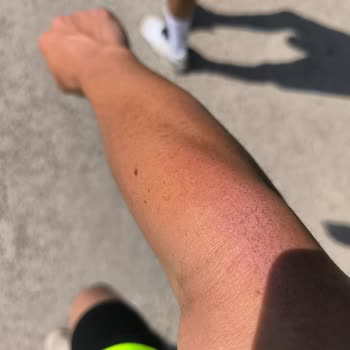 Veet Tüy Dökücü Krem Cildimde Yanık Ve Kalıcı Kaşıntı Yaptı, Çözüm Bekliyorum