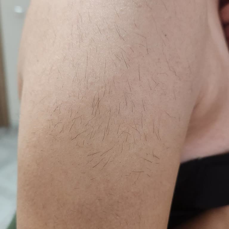 Epilasyon Sonrası Kolumda İstenmeyen Tüylenme Yaşadım