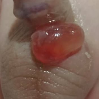 Sünnet Sonrası Ciddi Yanık Ve İlgisizlik