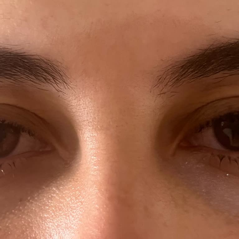 Lensci.com Lens Kullanımı Sonrası Gözde Yanma ve Kızarıklık, İade Talebine Olumsuz Yanıt